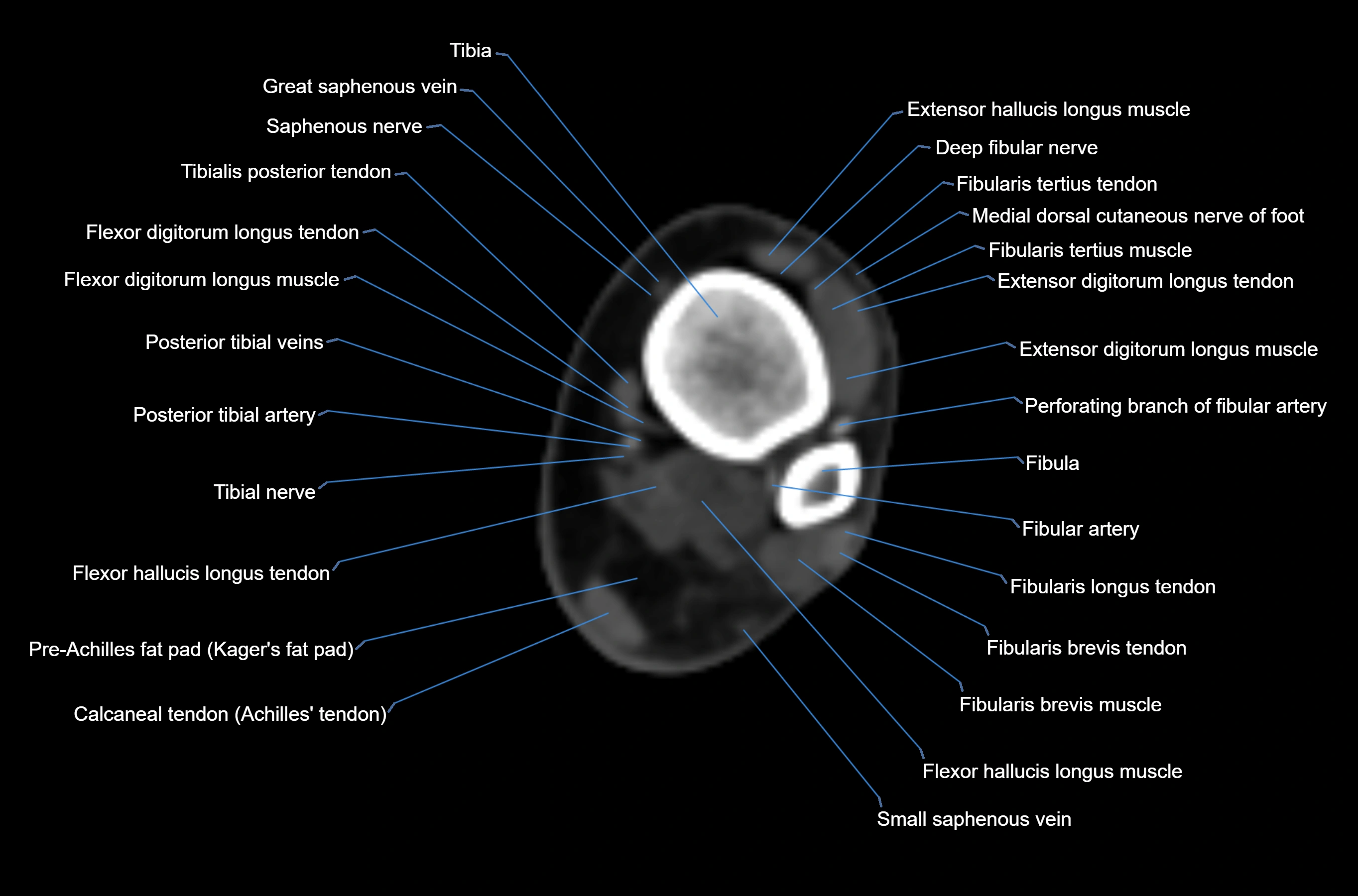 CT Ankle axial cross sectional anatomy labelled image -00020.webp